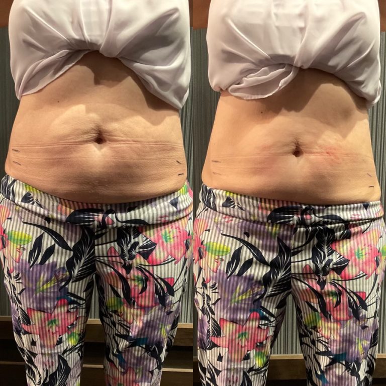 a woman's belly fat before and after