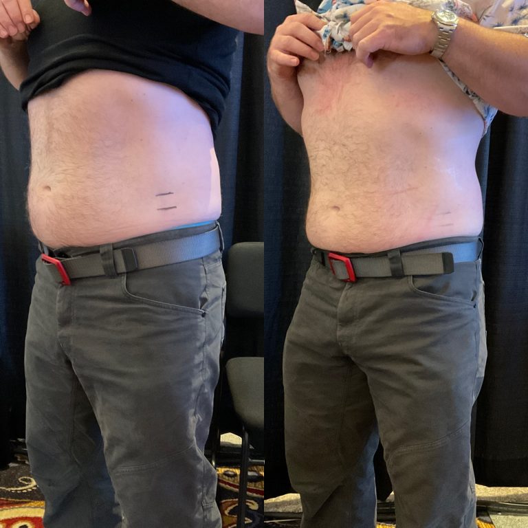 a mans belly fat before and after