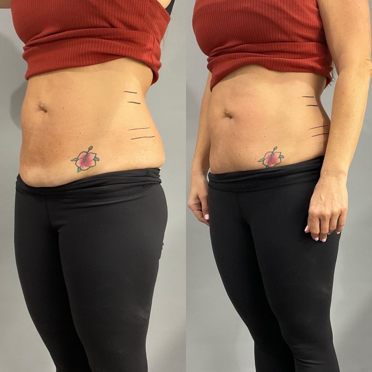 a woman's belly fat with tattoo before and after