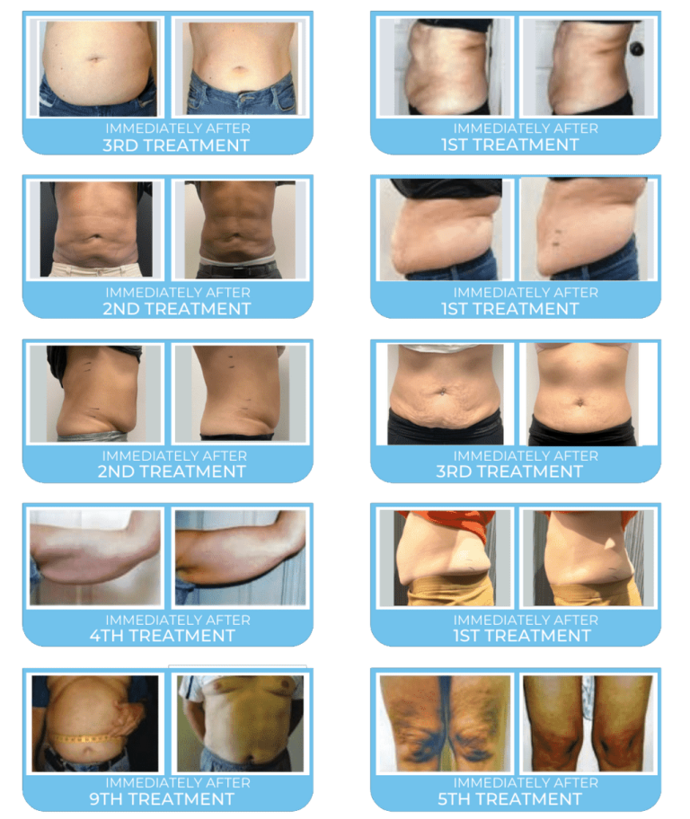 images of belly fats before and after