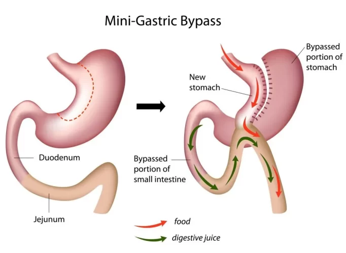 mini-gastric-bypass-omega-loop-gastric-bypass-bariatric-obesity-surgery-best-perth-weight-loss-surgeon-scaled-e1588058684933